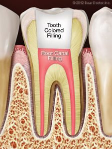 Root canal treatment with tooth-colored filling from Palmdale CA dentist