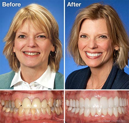 Before after photo of cosmetic dentistry in Palmdale CA