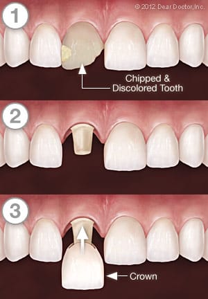 Crown series of a chipped and discolored tooth
