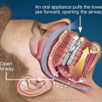 Oral sleep appliance that opens the airway