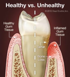 Comparison of healthy gum tissue and inflamed gum tissue
