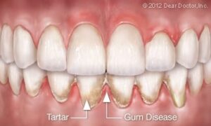 gum disease plaque and tartar buildup