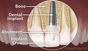 Dental Implants in Palmdale CA. Anatomy of a dental implant with an implant crown.