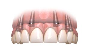 Illustration of Dental Implants on upper teeth.