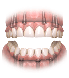 Illustration of Hybridge Dental Implants