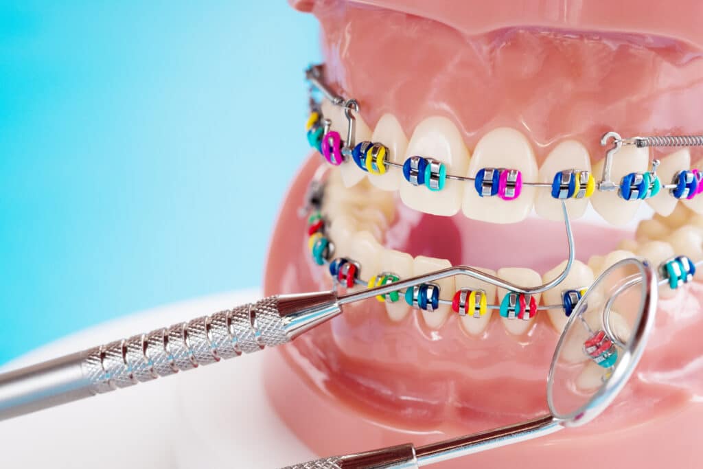 Benefits of Braces in Palmdale at AV Sierra Dental Center