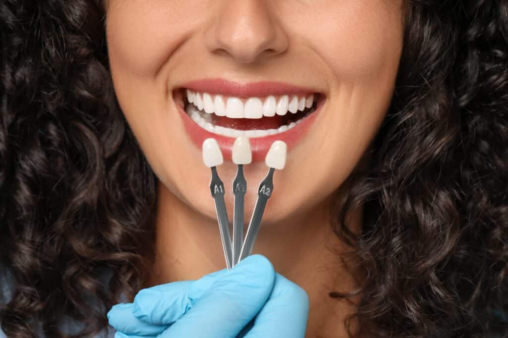 Dental Veneers Palmdale