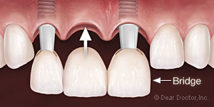 three unit dental bridge insertion at Palmdale CA dentist